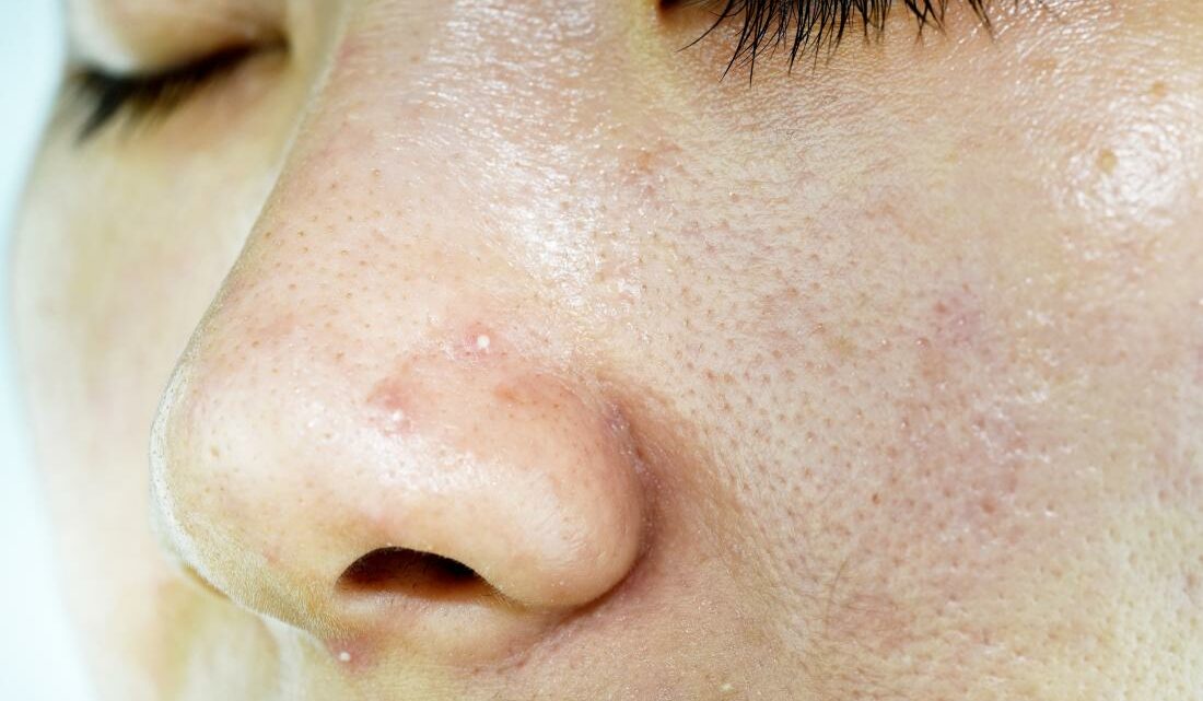 Come idratare una pelle acneica? Come idratare una pelle acneica?
