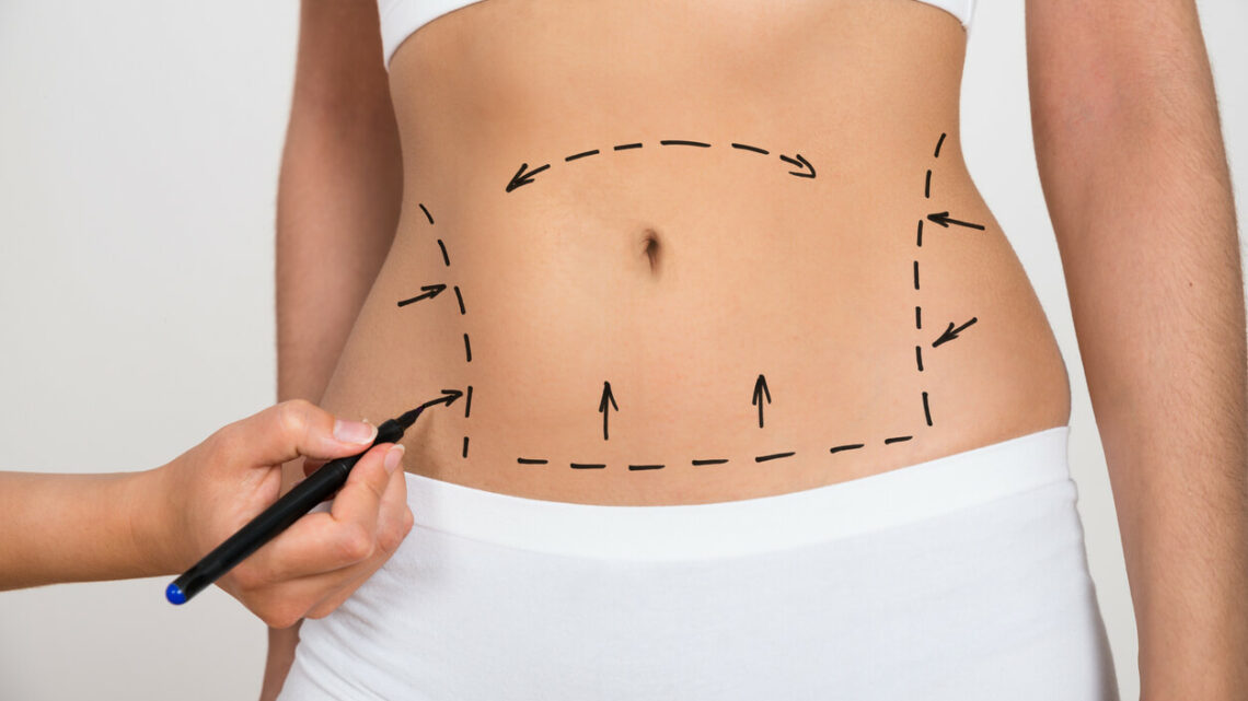 Liposuzione: in cosa consiste? Liposuzione: in cosa consiste?